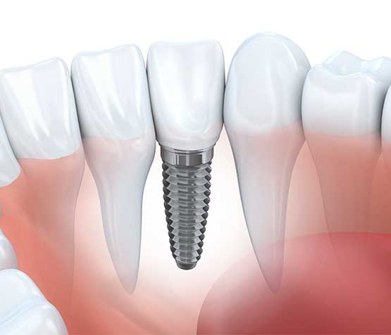 3D View of Dental Implant | Peace Periodontics