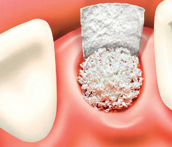 Dental Bone Graft | Peace Periodontics