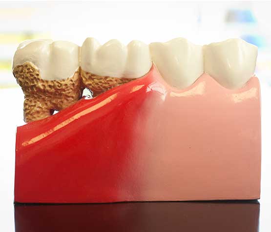 Gum Disease Model | Peace Periodontics