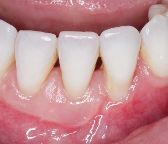 Gum Grafting After | Peace Periodontics