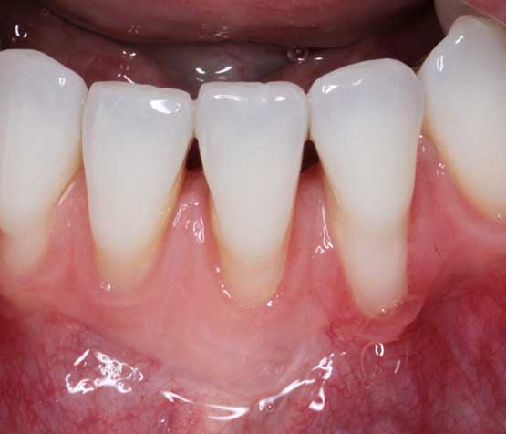 Gum Grafting Before | Peace Periodontics