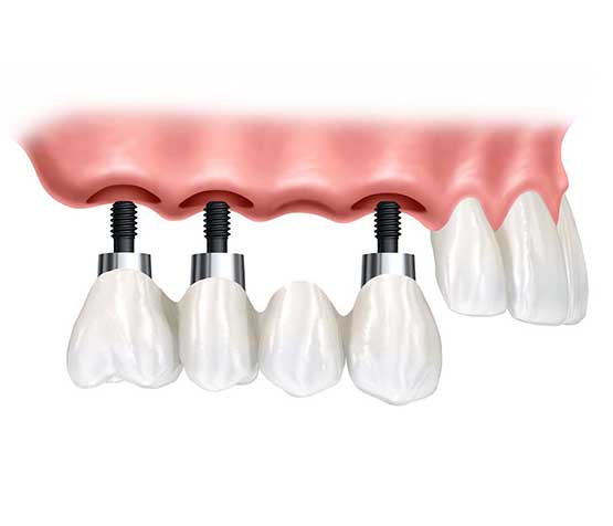 Implant Supported Bridge | Peace Periodontics