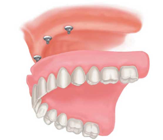 Implant Supported Denture | Peace Periodontics