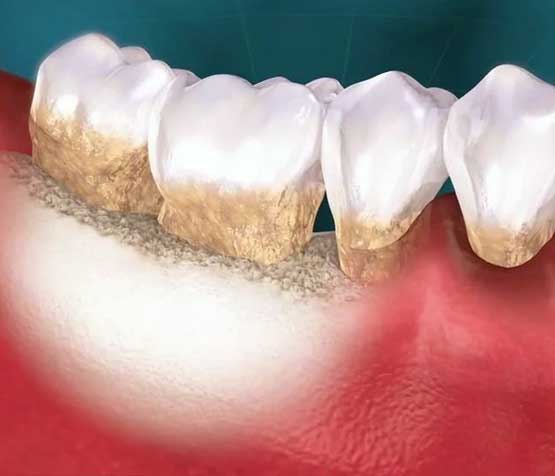 Osseous Dental Surgery