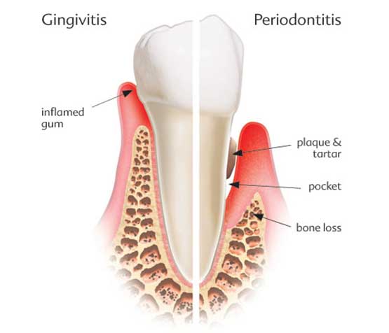 Periodontal Disease Diagram | Peace Periodontics