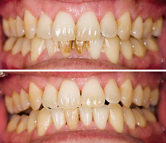 Plaque Removal Before After | Peace Periodontics
