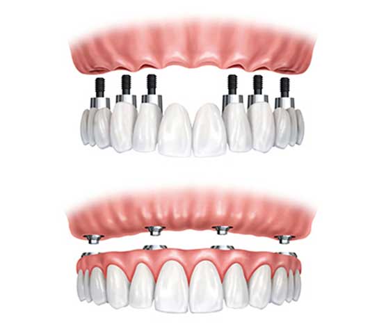 Replace Teeth With Implants | Peace Periodontics