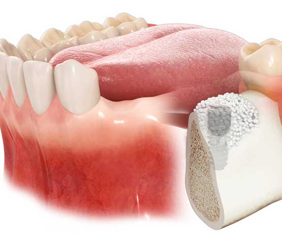 Ridge Augmentation