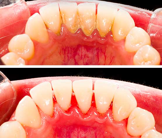 Scaling Before and After | Peace Periodontics