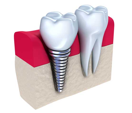 Single Tooth Dental Implant | Peace Periodontics